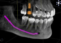 CT implant