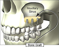 Sinus bone